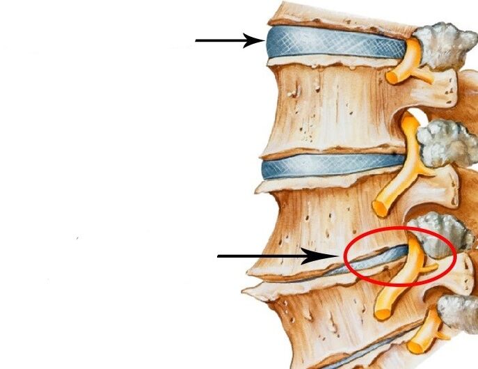 poškodený disk a porušené nervy krčnej osteochondrózy
