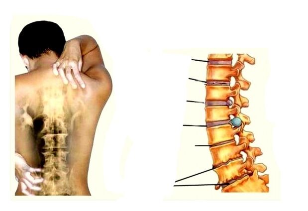 Štádiá rozvoja osteochondrózy