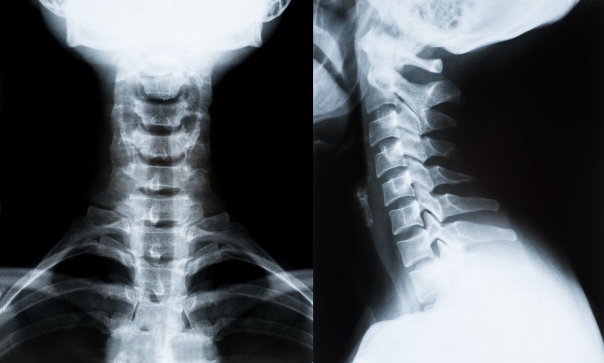 cervikálna osteochondróza na röntgene