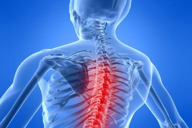 Kompresia miechy pri hrudnej osteochondróze